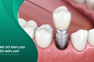 PHỤC HÌNH RĂNG SỨ TRÊN IMPLANT LÀ GÌ? QUY TRÌNH RA SAO?