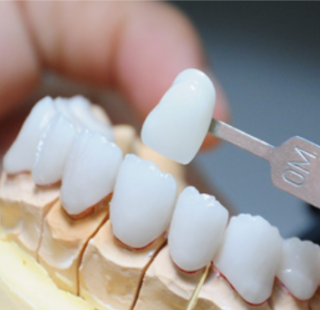 PHỤC HÌNH RĂNG SỨ TITAN