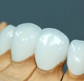 PHỤC HÌNH RĂNG SỨ LAVA