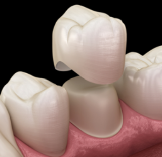 PHỤC HÌNH RĂNG SỨ CERAMILL ZOLID
